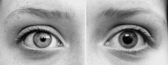before-and-after-dilation