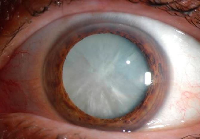 white-cataract