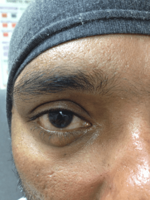 chalazion