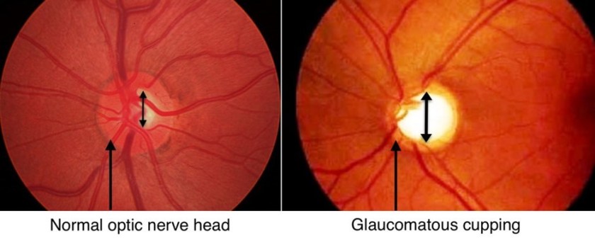 glaucoma-nerve-changes