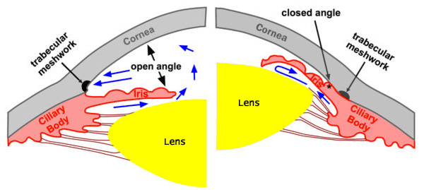 angle closure