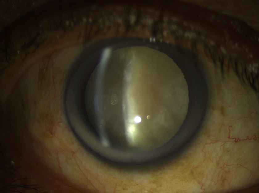 cataract white